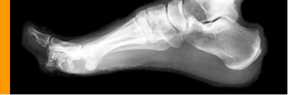 Orthotics foot x-ray